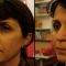 Injections de comblement