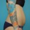 Abdominoplastika (Operace břicha)