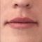 Lip Lift