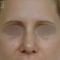 Operácia nosa (Rhinoplastika)