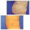 Liposukce
