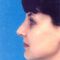 Plastika nosu (Rhinoplastika)
