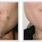 Laserové zákroky estetické dermatologie