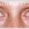 Korekcja powiek (Blepharoplastyka)