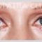 Korekcja powiek (Blepharoplastyka)