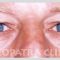 Korekcja powiek (Blepharoplastyka)