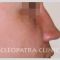 Plastika nosu (Rhinoplastika)