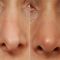 Plastika nosu (Rhinoplastika)