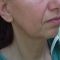 Facelift, SMAS facelifting