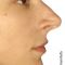 Plastika nosu (Rhinoplastika)