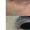 Lipofilling (grasso)
