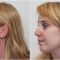 Laser acne treatment