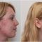 Laser acne treatment