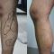 Varicose veins treatment