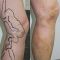 Varicose veins treatment
