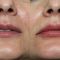 Kwas hialuronowy: Saypha, Restylane, Juvederm, Stylage