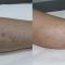 Sclerotization of varicose veins