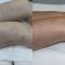 Sclerotization of varicose veins