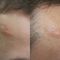 Laser Scar Treatment