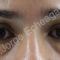 Cirugía de párpados (Blefaroplastia)