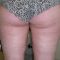 Body-jet liposukcja (WAL)