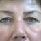 Eyelid surgery (Blepharoplasty)