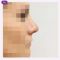 Operácia nosa (Rhinoplastika)