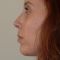 Rhinoplastie