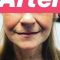 Facelift, SMAS Facelift