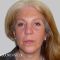 Facelift, SMAS Facelift