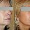 Lifting du visage