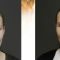 Ear surgery (Otoplasty)