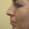 Rhinoplasty (Nose Job)