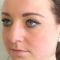 Rhinoplastie