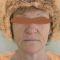 Facelift