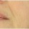 PRP – Plazma terapia (Drakula terapia)