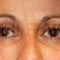 Lipofilling (grasso)
