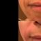 Filler antirughe a base di acido ialuronico