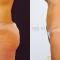 SlimLipo - laserová liposukcia