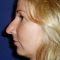 Plastika nosu (Rhinoplastika)