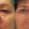 Eyelid surgery (Blepharoplasty)