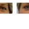 Eyelid surgery (Blepharoplasty)