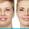 Sculptra