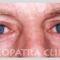 Operace očních víček (Blefaroplastika)