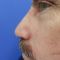 Plastika nosu (Rhinoplastika)