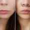 Lip Lift