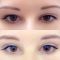 Korekcja powiek (Blepharoplastyka)