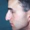 Plastika nosu (Rhinoplastika)