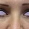 Eyelid surgery (Blepharoplasty)
