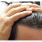 Greffe de cheveux